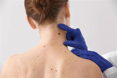 Ilustrácia dermatoskopického vyšetrenia znamienka
