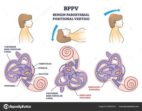 schéma polohovacích manévrov pri BPPV