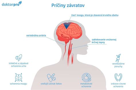 infografika znázorňujúca rôzne typy závratov a ich príčiny