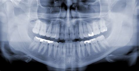 RTG snímka zubov s detailným zobrazením chrupu