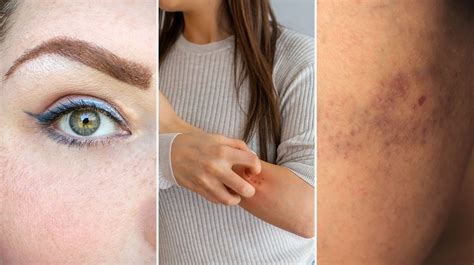 Schéma zobrazujúca priebeh kontaktnej alergie na koži (od kontaktu s predmetom po vznik ekzému)