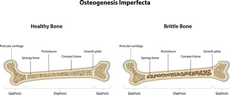 Infografika zobrazujúca štatistiku zlomenín u detí s osteogenesis imperfecta