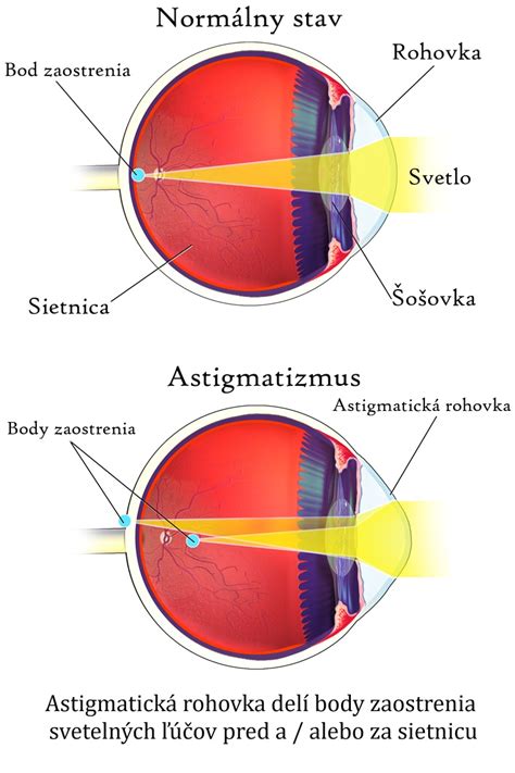 Schéma oka znázorňujúca prechod svetla cez rohovku a šošovku na sietnicu pri rôznych refrakčných vadách (myopia, hypermetropia, astigmatizmus).