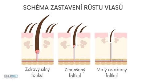 Schéma laserovej epilácie znázorňujúca pôsobenie lúča na vlasový folikul